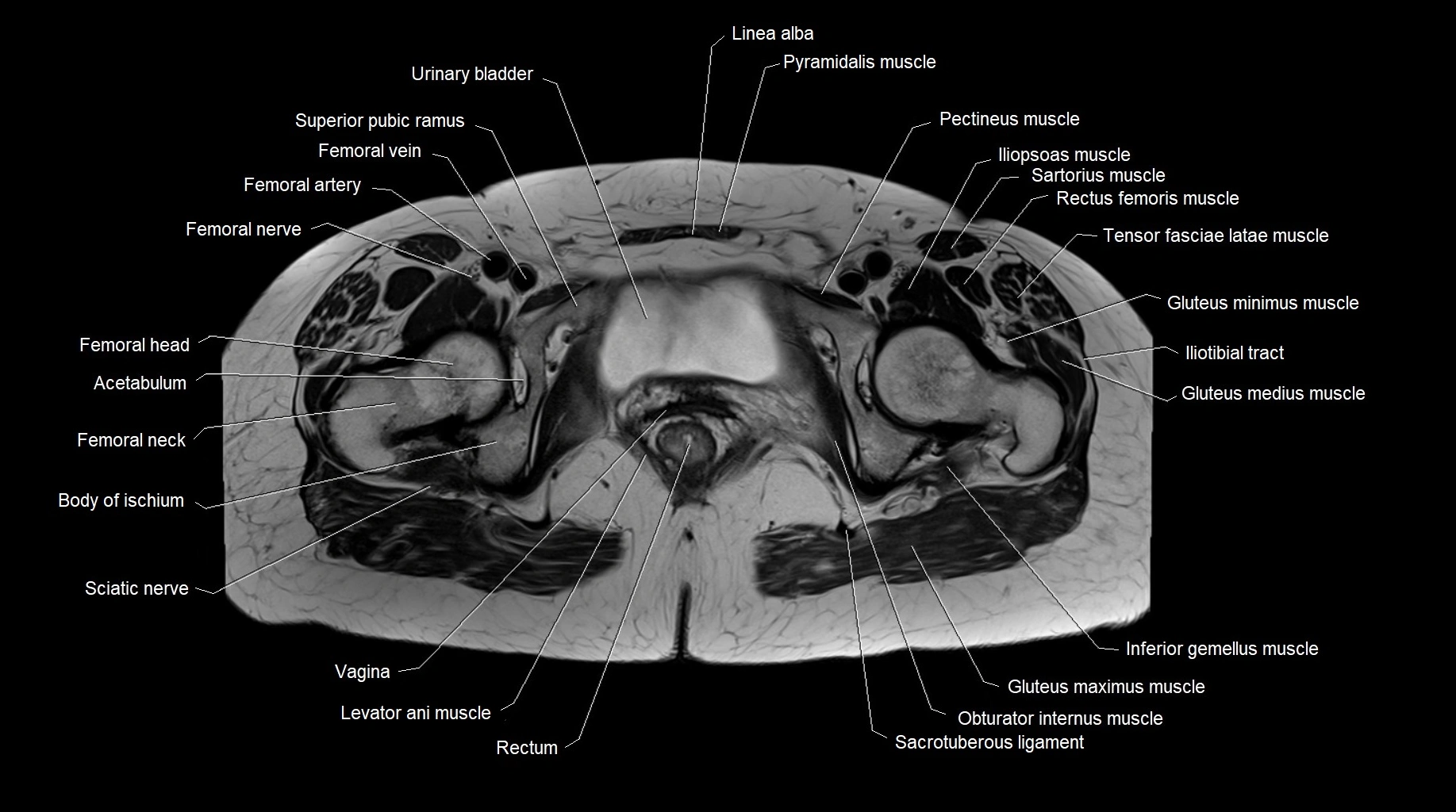 MRI 3T pelvis axial cross section anatomy image 25.webp